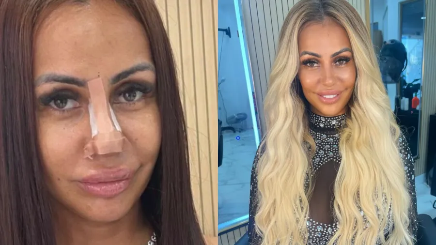 Influenciadora refaz harmonização facial após conselhos do ChatGPT