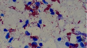 Exame de sangue associado a inteligência artificial abre caminho para diagnóstico precoce da hanseníase